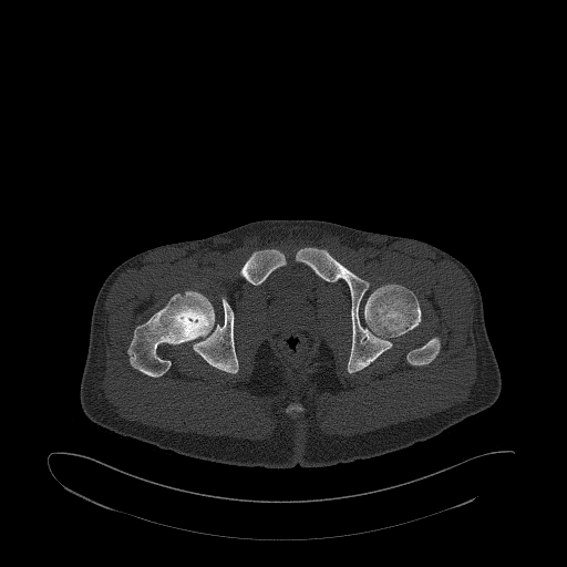 Brodie abscess- femoral neck (Radiopaedia 53862-59966 Axial bone window 165).jpg