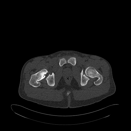 Brodie abscess- femoral neck (Radiopaedia 53862-59966 Axial bone window 173).jpg
