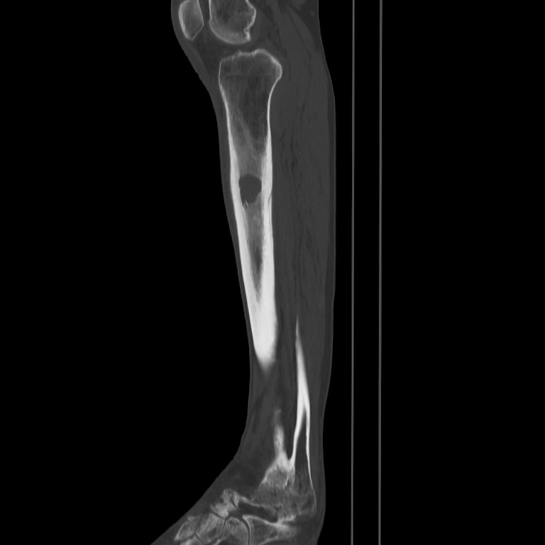 Brodie abscess - tibia (Radiopaedia 66028-75204 Sagittal bone window 40).jpg