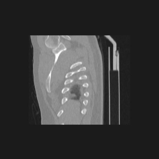Bronchial atresia (Radiopaedia 60685-68439 Sagittal lung window 2).jpg
