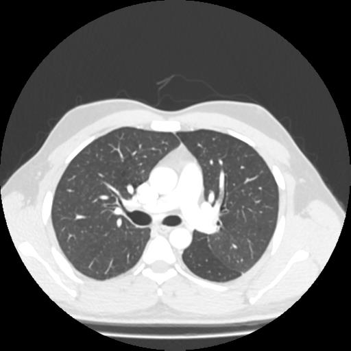 File:Bronchial carcinoid (Radiopaedia 80013-93291 Axial lung window 43).jpg