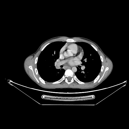 Bronchial carcinoid tumor (Radiopaedia 57187-64090 A 37).jpg