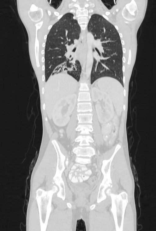 Bronchial carcinoid tumor (Radiopaedia 57187-64090 Coronal lung window 66).jpg