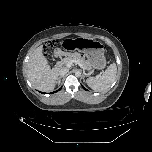 Bronchial carcinoid tumor (Radiopaedia 78272-90870 C 126).jpg