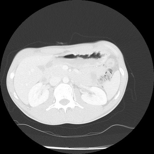Bronchial carcinoid tumor causing right lower lobe collapse (Radiopaedia 83495-98594 Axial lung window 62).jpg