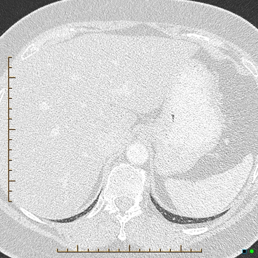 Bronchial diverticula (Radiopaedia 79512-92676 Axial lung window 204).jpg