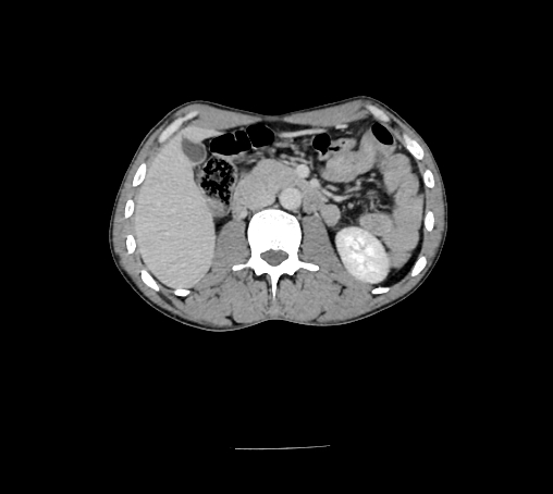 File:Bronchiectasis in Crohn disease (Radiopaedia 60311-67977 B 73).jpg