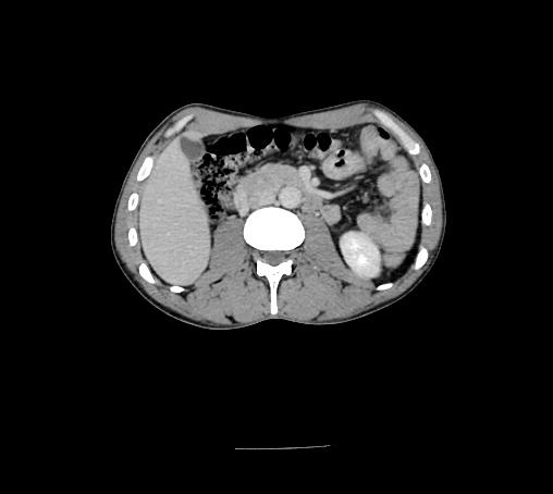 Bronchiectasis in Crohn disease (Radiopaedia 60311-67977 B 76).jpg