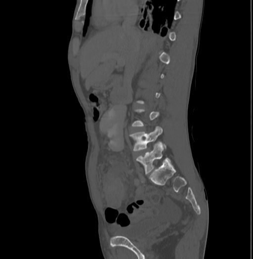 Bronchiectasis in Crohn disease (Radiopaedia 60311-67977 Sagittal bone window 93).jpg