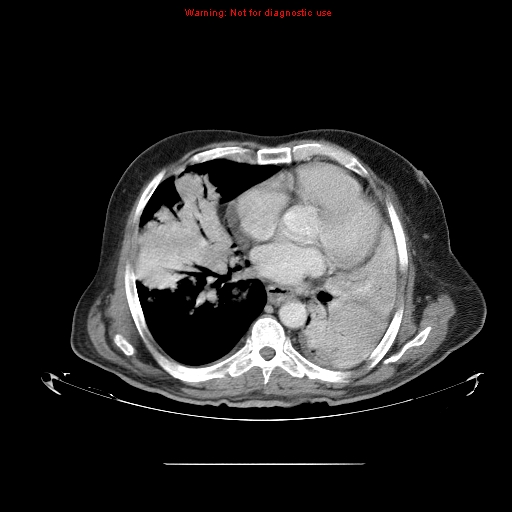 File:Bronchioloalveolar carcinoma (Radiopaedia 9272-9955 A 18).jpg