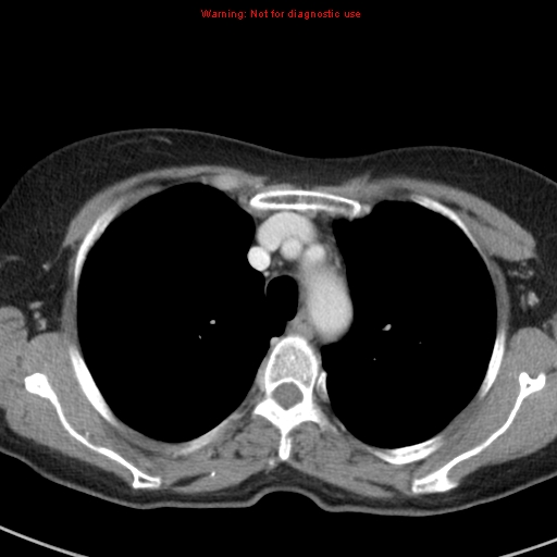 File:Bronchoalveolar carcinoma (BAC) (Radiopaedia 13436-13392 B 14).jpg