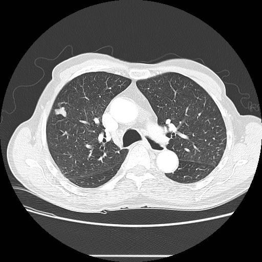 Bronchocele (Radiopaedia 17097-16795 Axial lung window 45).jpg