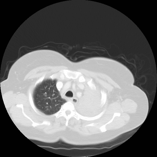 File:Bronchogenic carcinoma (Radiopaedia 73497-84262 Axial lung window 21).jpg