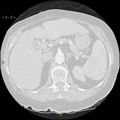 Bronchogenic carcinoma as an incidental finding (Radiopaedia 16453-16130 Axial lung window 3).jpg