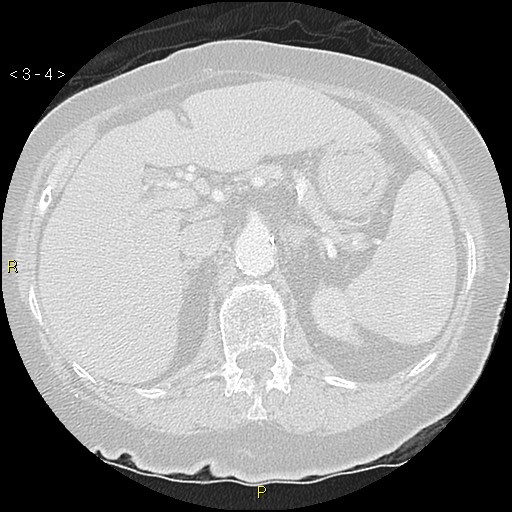 Bronchogenic carcinoma as an incidental finding (Radiopaedia 16453-16130 Axial lung window 4).jpg