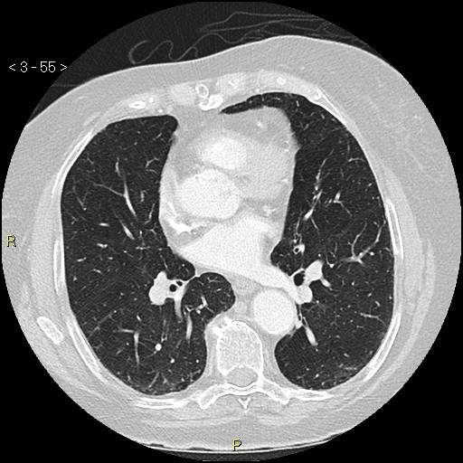 Bronchogenic carcinoma as an incidental finding (Radiopaedia 16453-16130 Axial lung window 55).jpg