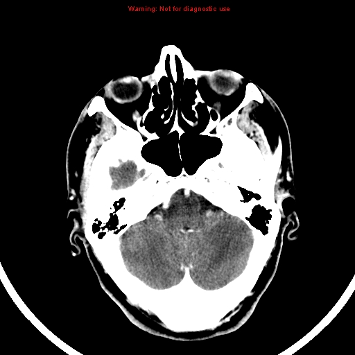 File:Bronchogenic carcinoma brain metastasis (Radiopaedia 9286-9970 B 6).jpg