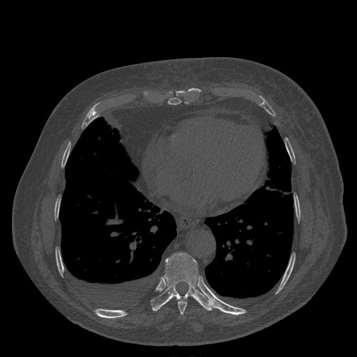 Bronchogenic carcinoma with metastatic lymphadenopathy (Radiopaedia 37671-39569 Axial bone window 38).jpg