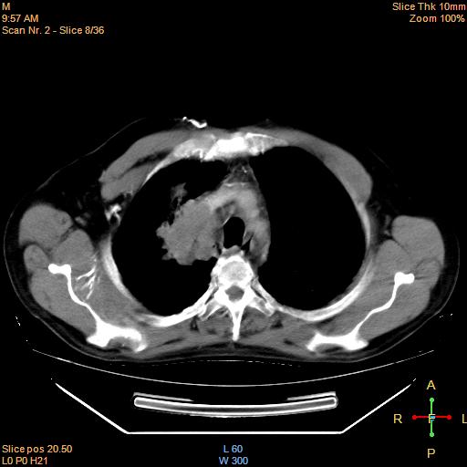 File:Bronchogenic carcinoma with superior vena caval invasion (Radiopaedia 22378-22406 Mediastinal window 6).jpg