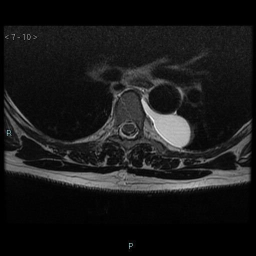 File:Bronchogenic cyst - posterior mediastinal (Radiopaedia 43885-47365 Axial T2 10).jpg