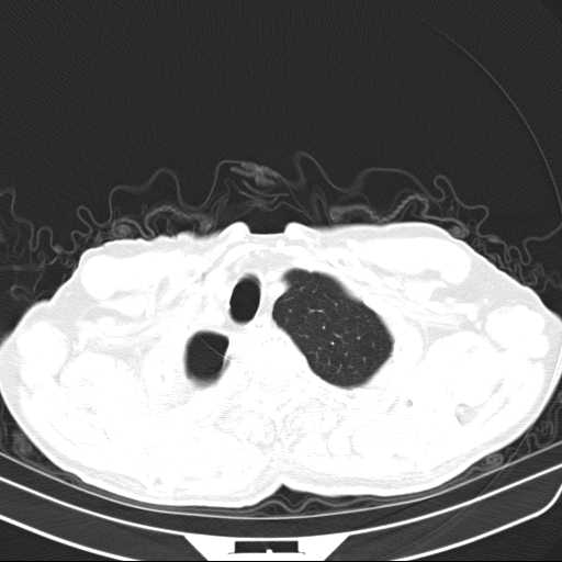 Bronchopleural fistula - postoperative complication (Radiopaedia 21020-20947 Axial lung window 6).jpg