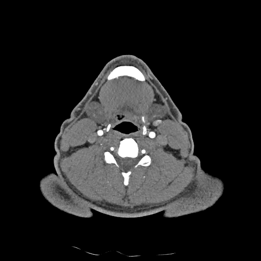 Buccal fat pad arteriovenous malformation (Radiopaedia 70936-81144 D 132).jpg