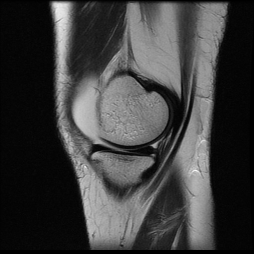 File:Bucket handle meniscus tear (Radiopaedia 56916-63751 Sagittal T2 16).jpg