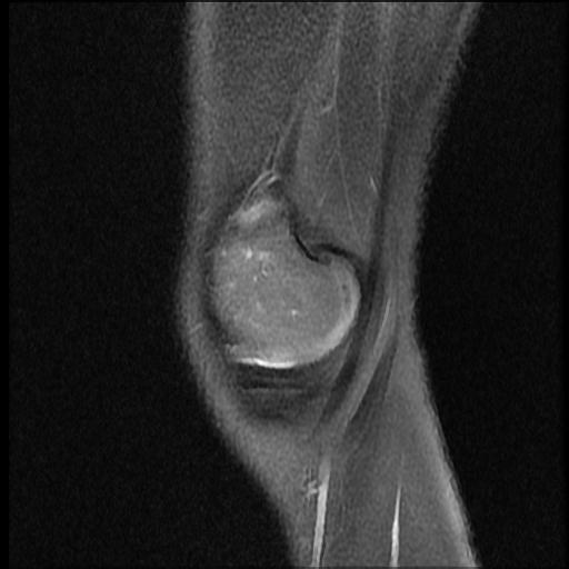 File:Bucket handle tear - lateral meniscus (Radiopaedia 72124-82634 Sagittal PD fat sat 15).jpg