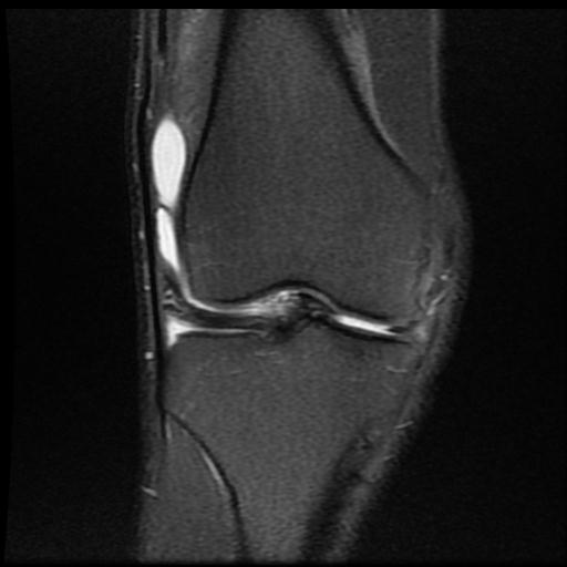 File:Bucket handle tear - medial meniscus (Radiopaedia 69245-79026 Coronal PD fat sat 8).jpg