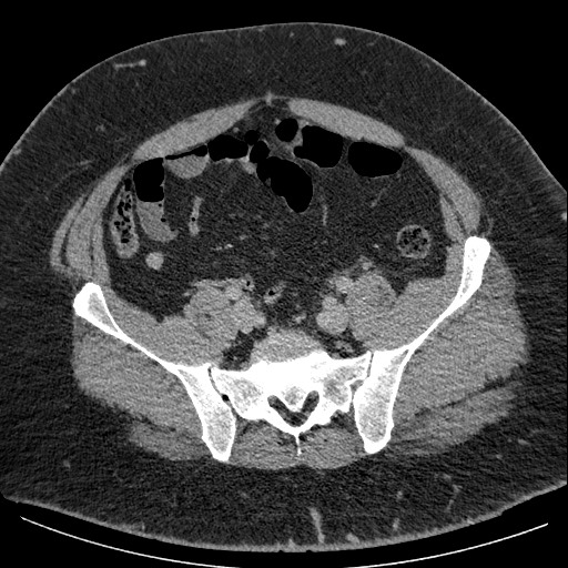 Burned-out testicular seminoma - retroperitoneal nodal metastases (Radiopaedia 62872-71245 A 55).jpg