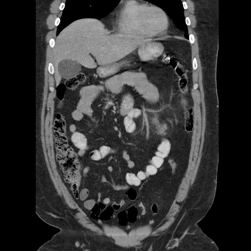 Burned-out testicular seminoma - retroperitoneal nodal metastases (Radiopaedia 62872-71245 B 23).jpg