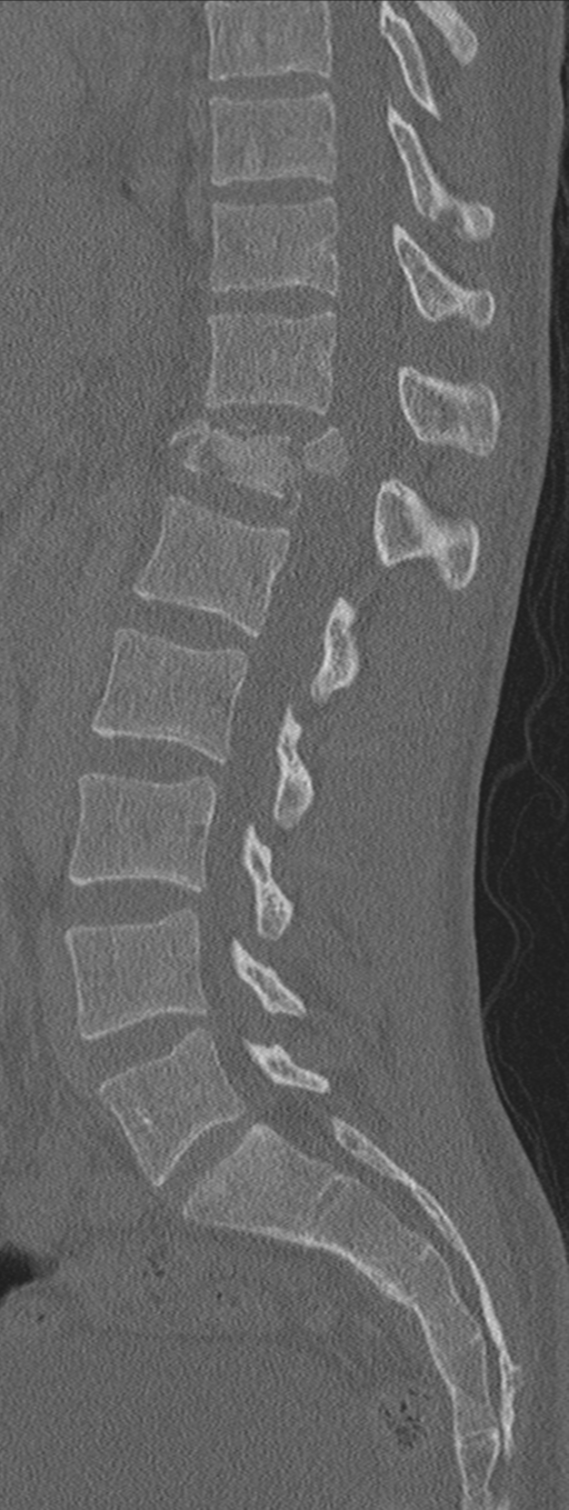 Burst fracture - T12 with conus compression (Radiopaedia 56825-63647 Sagittal bone window 39).png