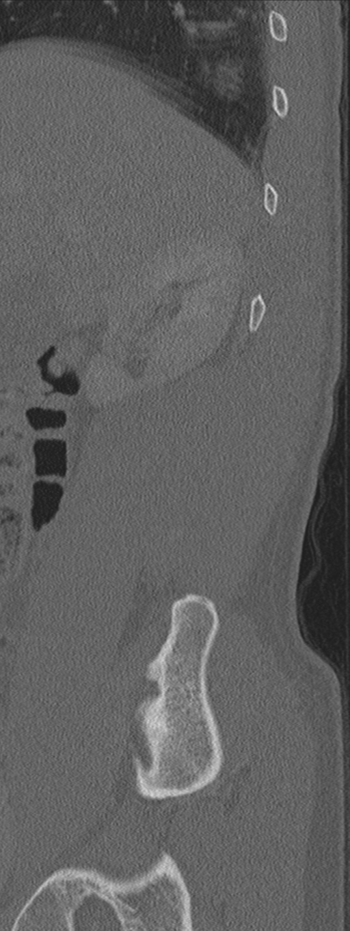 Burst fracture - T12 with conus compression (Radiopaedia 56825-63647 Sagittal bone window 81).png