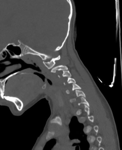 Butterfly vertebra (Radiopaedia 77903-90209 Sagittal bone window 16).jpg