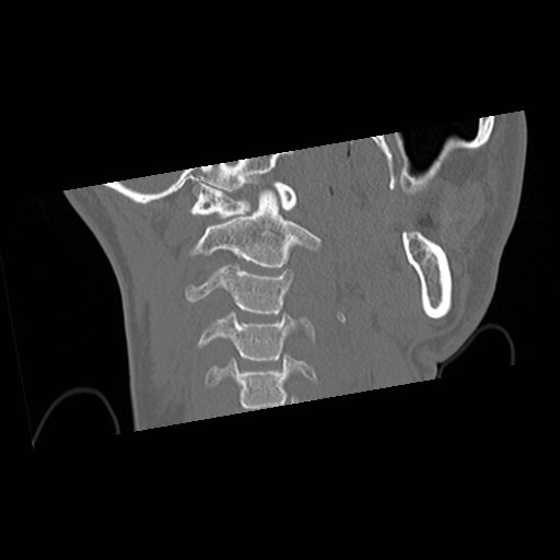 C1-C2 "subluxation" - normal cervical anatomy at maximum head rotation (Radiopaedia 42483-45607 Coronal non-contrast 17).jpg