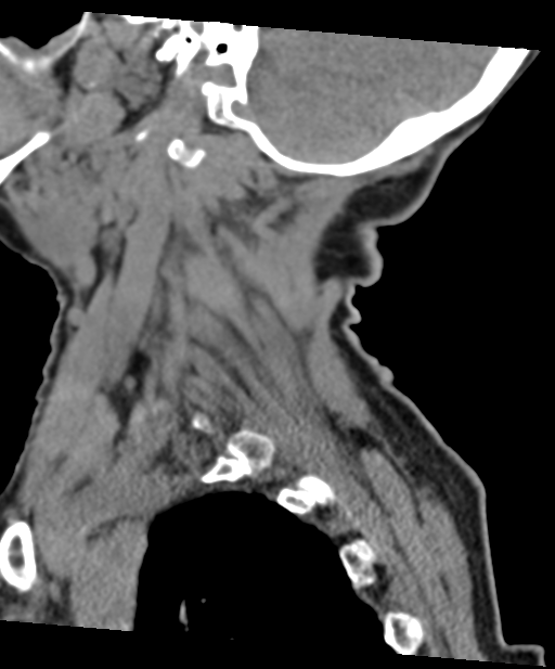 C2 fracture with vertebral artery dissection (Radiopaedia 37378-39199 D 62).png