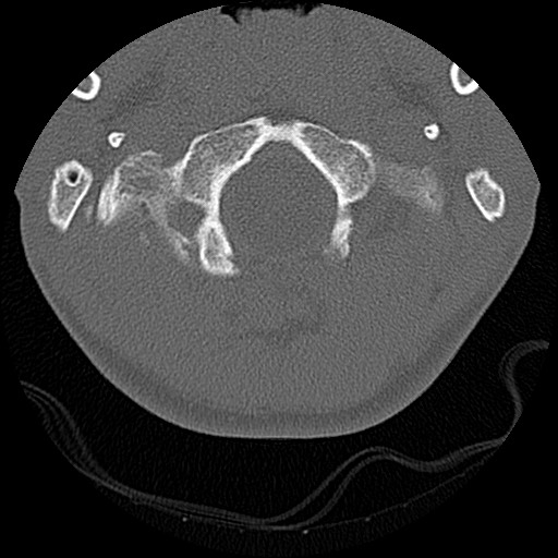 File:C5 facet fracture (Radiopaedia 58374-65499 Axial bone window 8).jpg