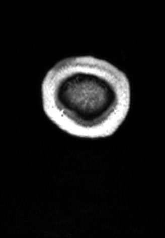 CNS cryptococcosis (Radiopaedia 70895-81108 Coronal T1 C+ 193).jpg