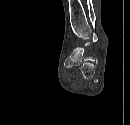 Calcaneal fracture - Sanders type 4 (Radiopaedia 90179-107370 Coronal bone window 57).jpg