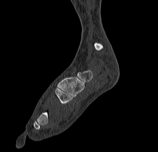 Calcaneal fracture - Sanders type 4 (Radiopaedia 90179-107370 Sagittal bone window 29).jpg