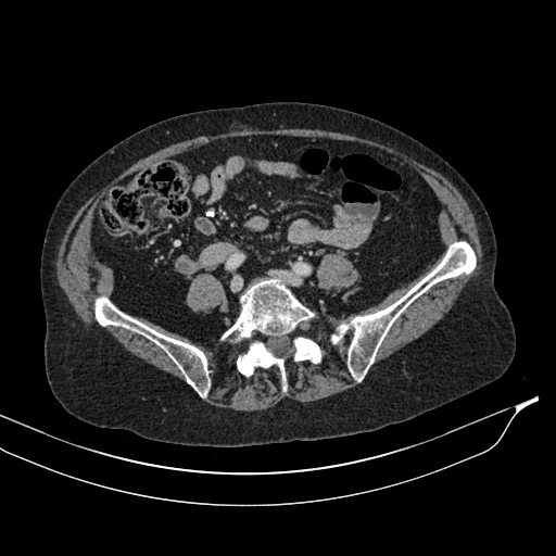 Calcified adrenal glands and Spigelian hernia (Radiopaedia 49741-54988 A 152).jpg