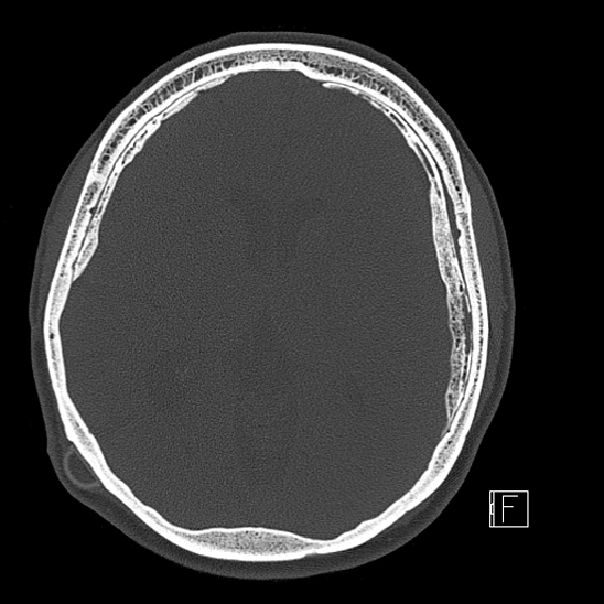 Calcified chronic subdural hematoma (Radiopaedia 77374-89492 Axial bone window 70).jpg