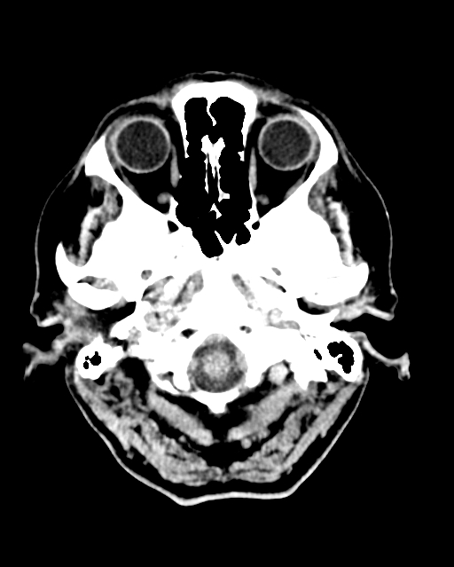 Calcified meningioma (Radiopaedia 74361-85243 Axial non-contrast 46).jpg