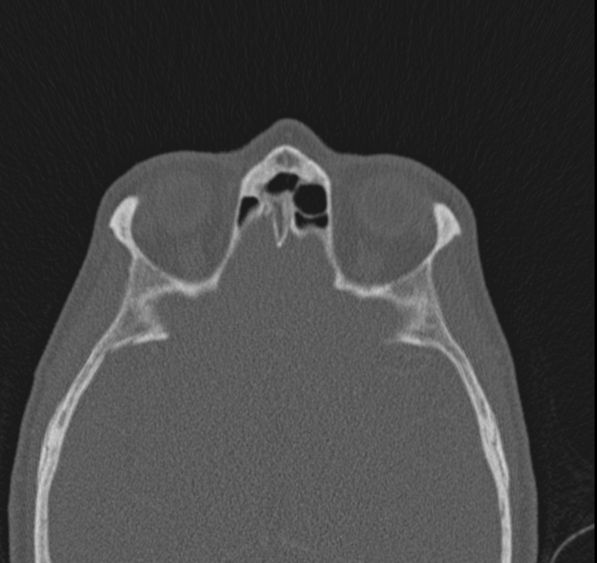 Caldwell-Luc operation (Radiopaedia 52329-58225 Axial bone window 17).jpg