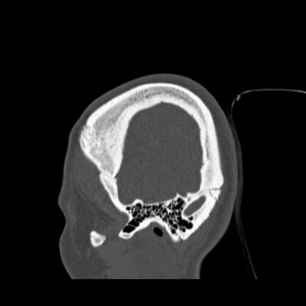 Calvarial osteoma (Radiopaedia 36520-38079 Sagittal bone window 15).jpg