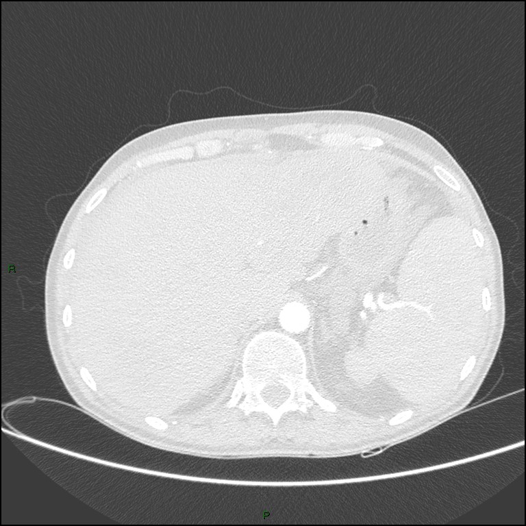 Cannonball metastases (Radiopaedia 82110-96150 Axial lung window 187).jpg