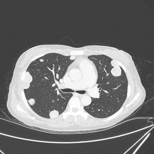 File:Canonball lung metastasis (Radiopaedia 77634-89837 Axial lung window 77).jpg