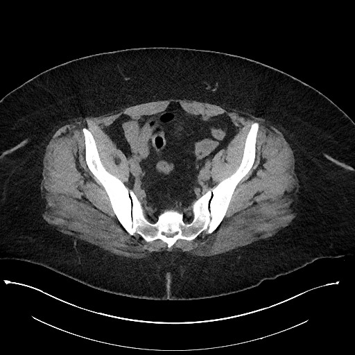 Carcinoid tumor - terminal ileum (Radiopaedia 60931-68740 Axial non-contrast 97).jpg