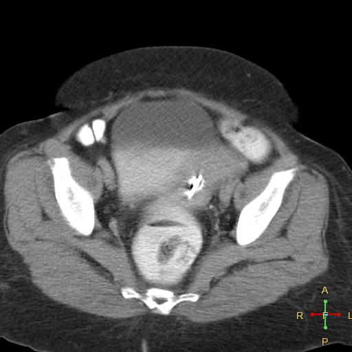 File:Carcinoma of sigmoid colon (Radiopaedia 23071-23100 C+ delayed 24).jpg