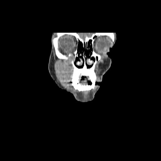 Carcinoma of the maxillary antrum (Radiopaedia 53805-59888 Coronal C+ delayed 20).jpg